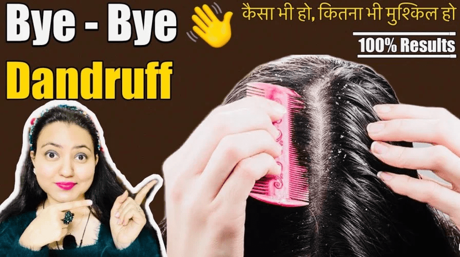 Read more about the article How To Treat Dandruff At Home | Preity Prerna