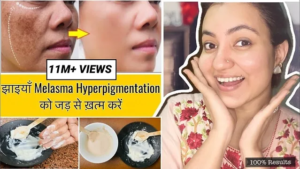 Read more about the article Hyperpigmentation Treatment