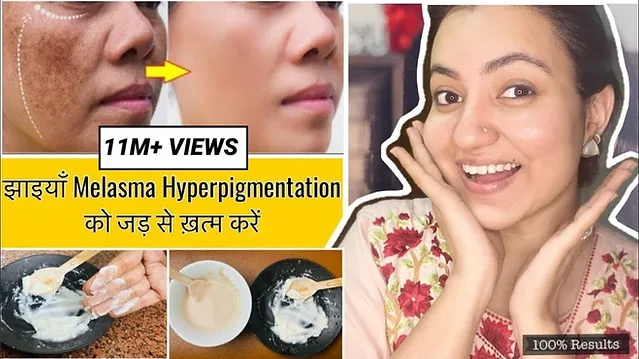 Read more about the article How to Treat Hyperpigmentation – Reasons, Symptoms and Treatment