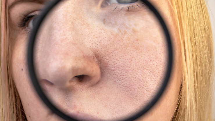 Read more about the article Home Remedy For Open Pores