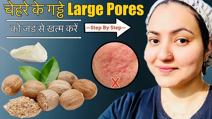 Read more about the article Best Remedy for Acne Scars, Open Pores, Large Pores & Dark Spots | Preity Prerna