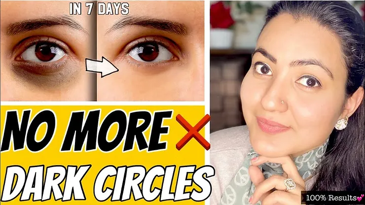 Read more about the article Remove Dark Circles Permanently At Home  in 7 Days